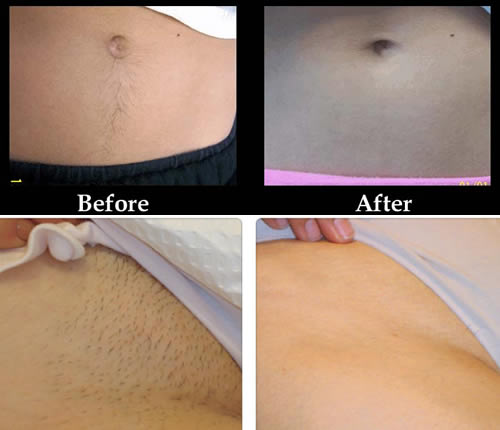 Hair removal of Bikini area with Laser Treatment