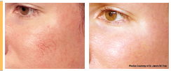 Facial veins Laser Treatment