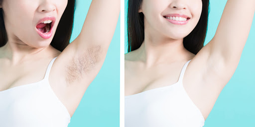 Hair Removal of Axilla with Laser Treatment