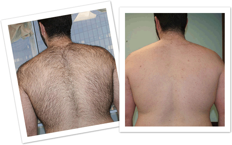 Hair removal of Back with Laser Treatment